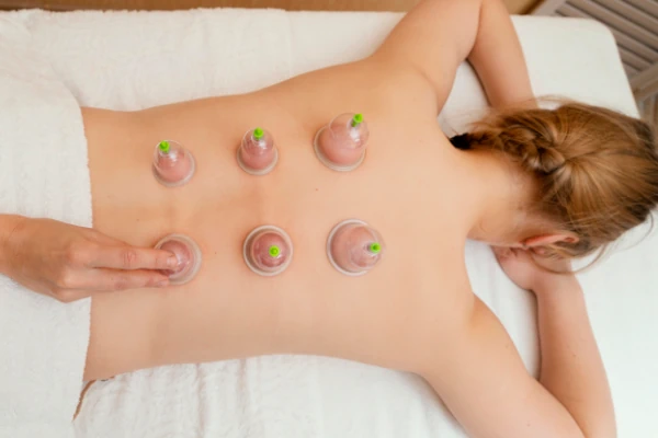 Cupping Therapy 32 Restore Balance and Reinvigorate Your Body: Embrace Healing with Cupping Therapy.